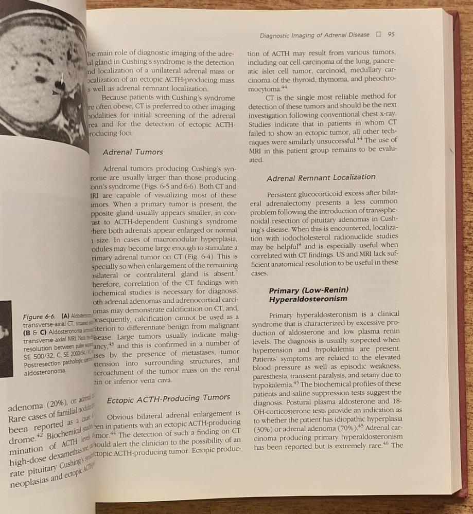 Surgery of the Adrenal Glands (Chirurgia nadobličiek)